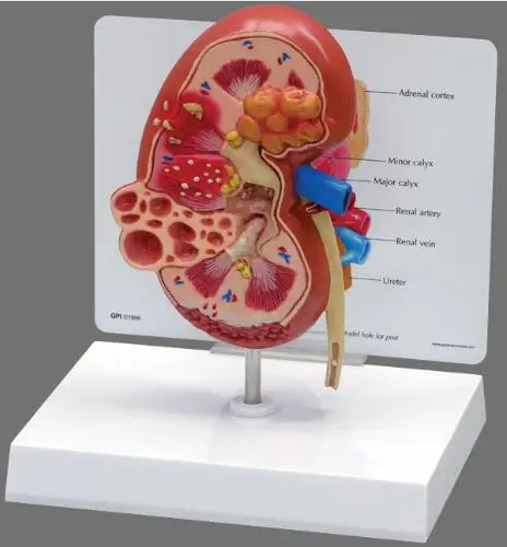 

Kidney stones Disease Model Urology Kidney Nephron Renal Glomerulus Anatomical Model Renal Anatomy Model Medical Teaching Supply