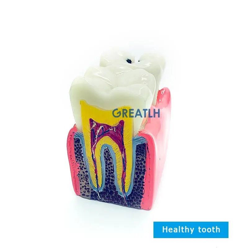 Teeth Model Teeth Disease Teaching Model Caries Model Dental Model Dentistry Products