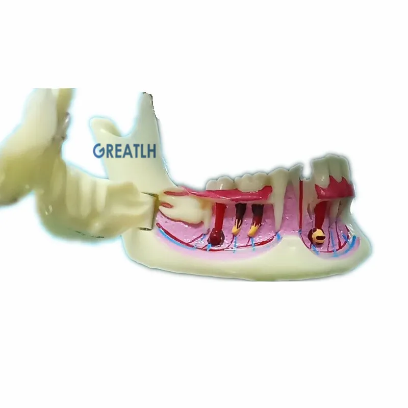 Dental leczenie endodontyczne Model anatomia dziąseł badanie stomatologiczne naucz Model zębów