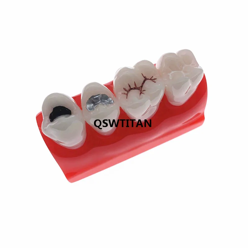 Teaching Resources Dental Study Model for Pit and Fissure Sealing Treatment Teeth Model