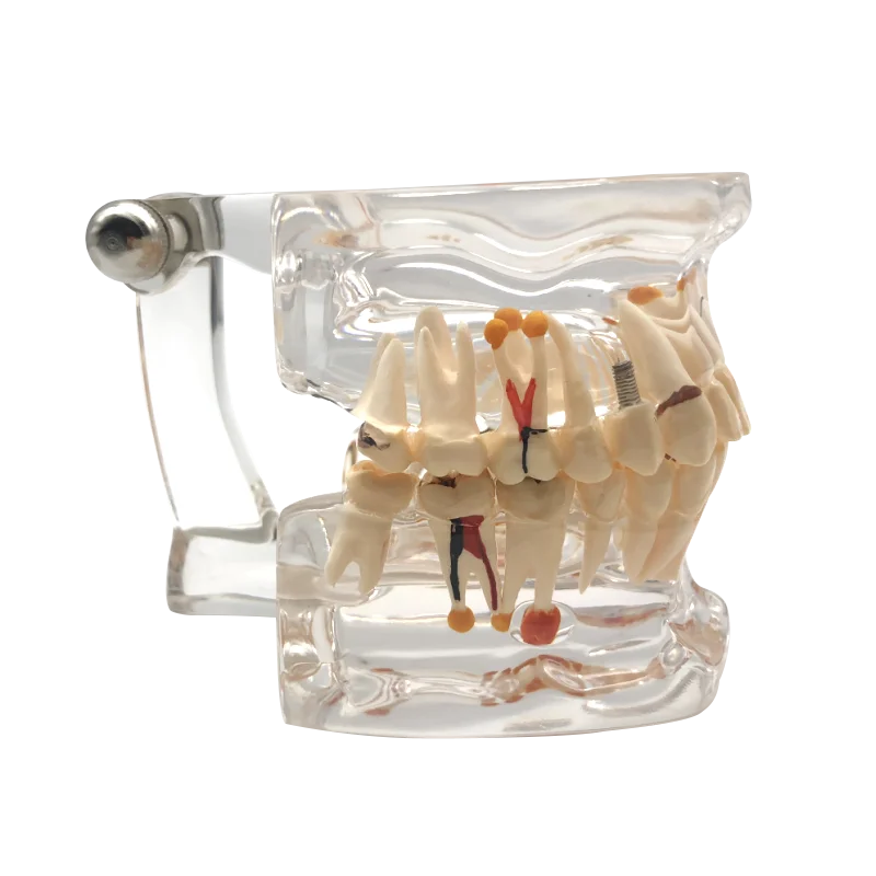 

Full mouth pathology model 32 teeth Dental Implant Disease Teeth Model With Restoration Bridge Tooth Dentist For Medical Science