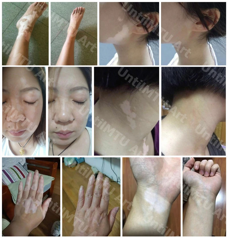 Vitiligo Makeup Waterproof Instant Skin Patches Coating Cover Lotion Conceal Pen on Face Body for Women Men Kids XISHENGYAN 5pc