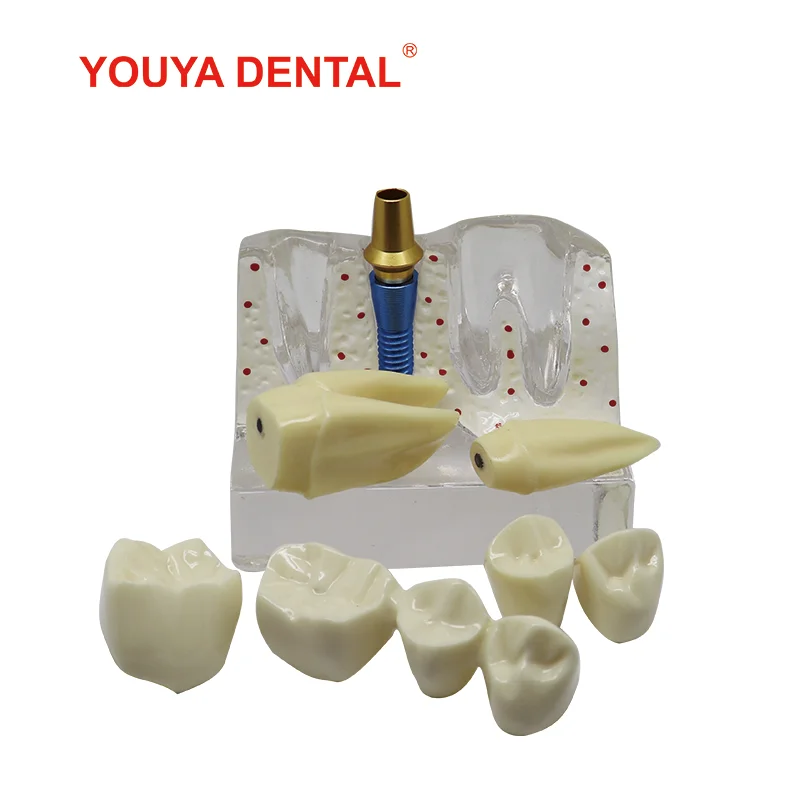 New 4 Times Implant Dental Model Teeth Teaching Model For Studying  Dentist Patient Education Demonstration Dentistry Products