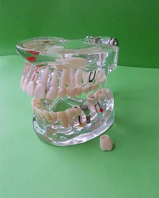 

Dental Materials Oral dental Adult pathology model free shipping