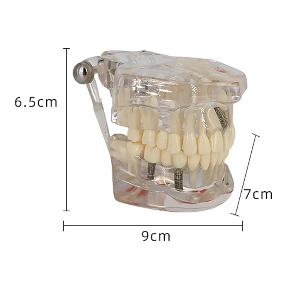 Transparent Disease Teeth Model Dental Implant Teeth Model Dentist Dental Student Learning, Teaching, Research Communication