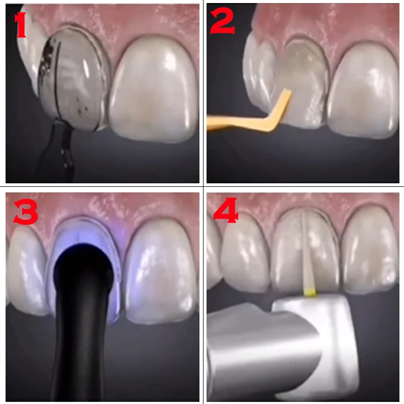 Dental Mould For Composite Resin Veneers Light Cure Filling Anterior Front Teeth Tooth Whitening Dentistry Lab Materials A