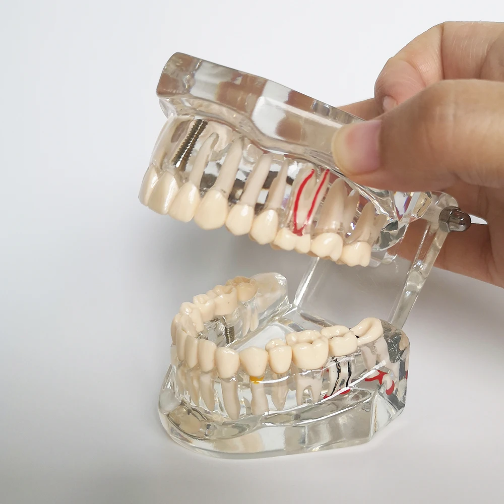 Neues Dentalmodell für Zahnimplantate, Restaurationsbrücken, Lehrmaterial für Medizinische Wissenschaft, Krankheiten, Zahnärzte und Zahnmedizinprodukte – Detail 5