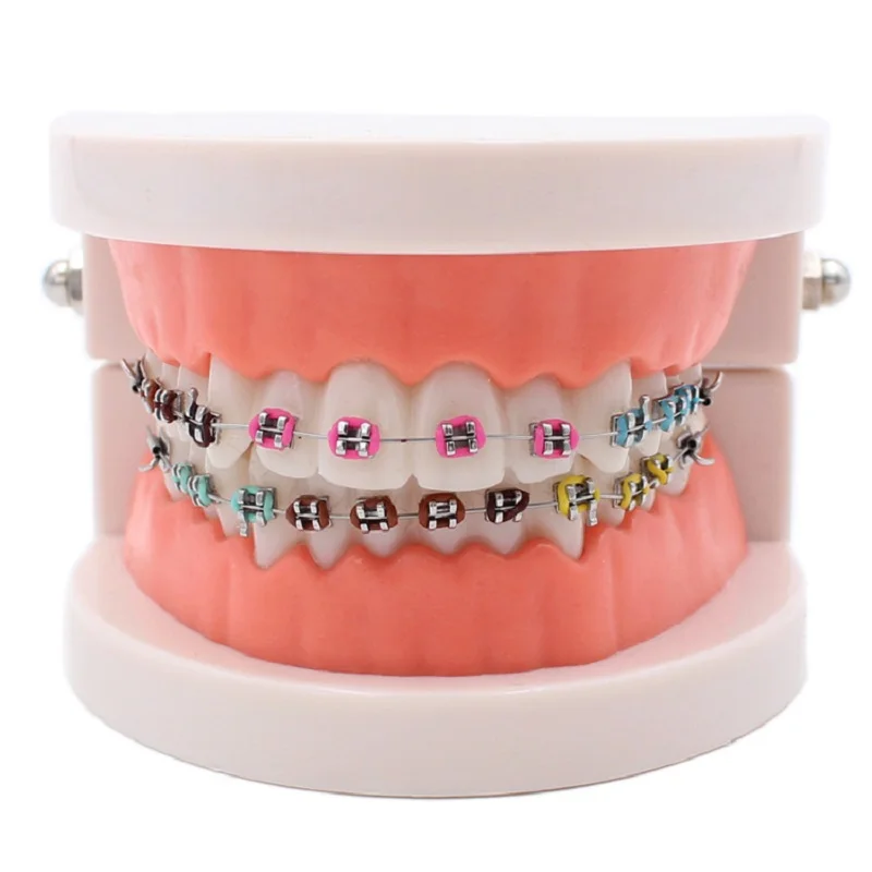 Dental Orthodontic Treatment Model With Ortho Metal Ceramic Bracket Arch Wire Buccal Tube Ligature Ties Dentist Tools Lab