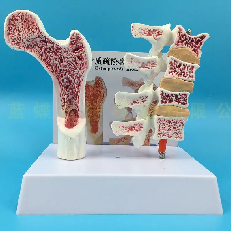 Human femoral osteoporosis anatomical model leg bone anatomical plane spinal section specimen pathological model lumbar spine