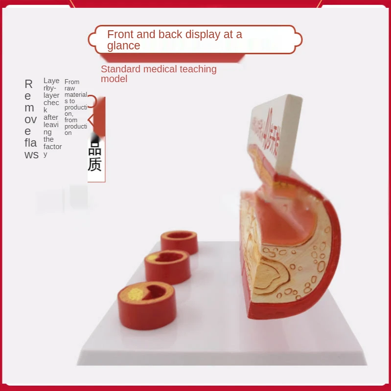 Thrombosis model Display model of age vessels at different stages of cardiovascular arteriosclerosis of human atherosclerosis