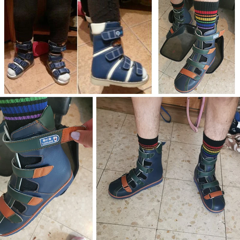 Baby Meisje Sandalen Zomer Orthopedische Schoenen Voor Kinderen Hoge Top Jongens Tipsie Klompvoet Gesloten Teen Lederen Schoeisel Met Orthopedische