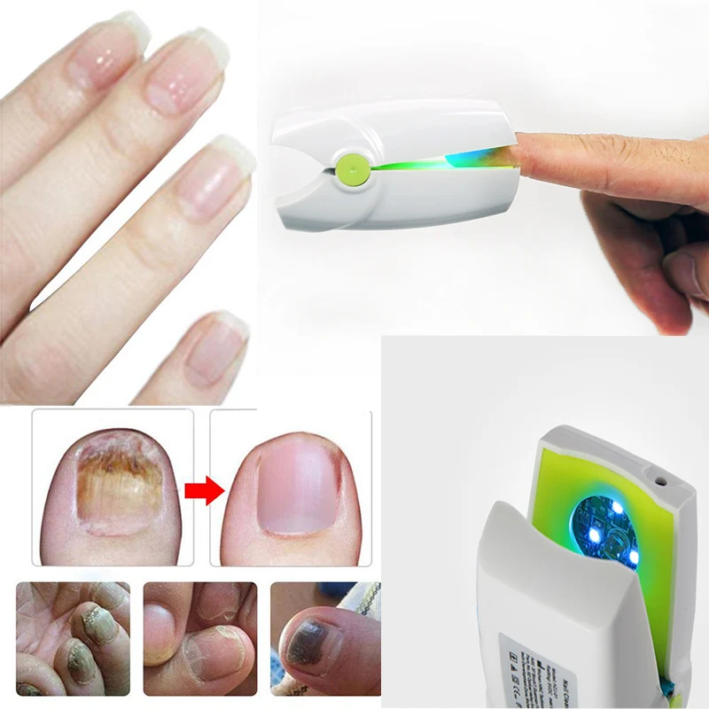 Remove Nail Fungus Laser Device Onychomycosis Treatment Toenail Fungal Finger Renew