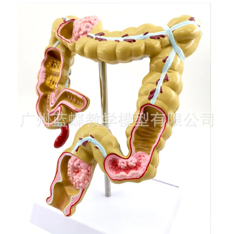 1/2 Life Size Human Rectal Pathology Colon Model Large Intestine Model Anorectal Anatomical Model Tools