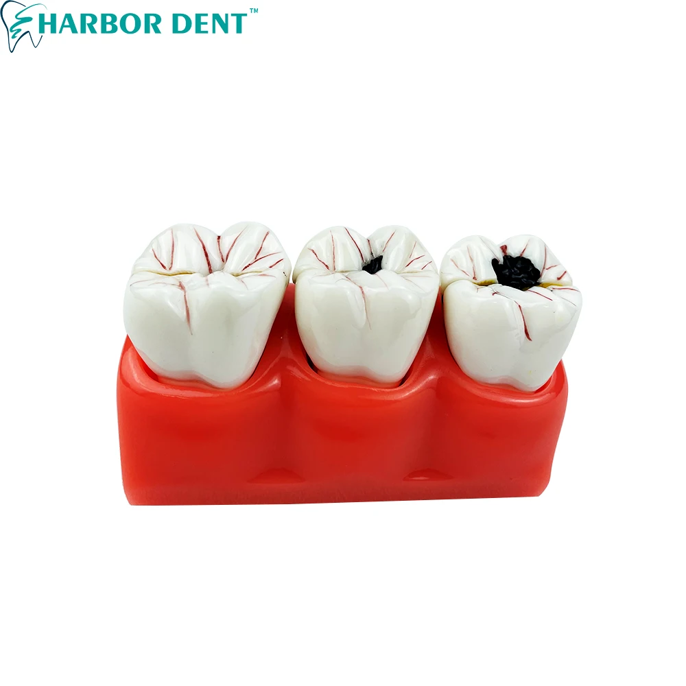 

3 Times Caries Disassembling Model Denture Disease Teeth Model for Dentist Tooth Decay Model for Teaching Decomposition Model