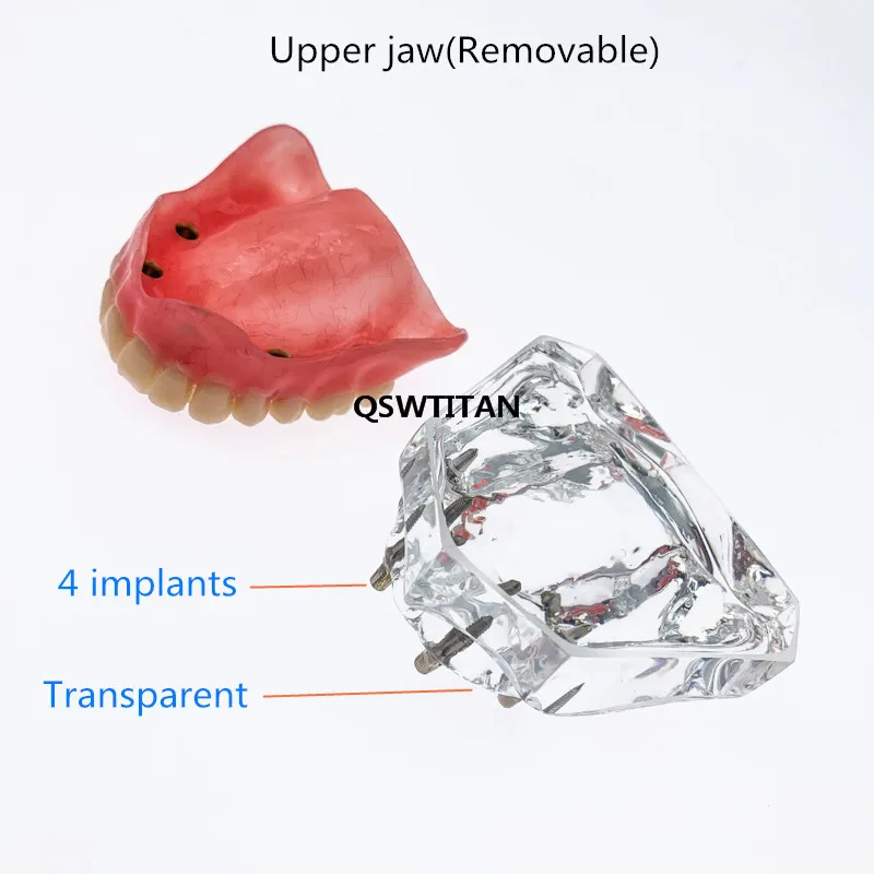 Dental Teeth Model With Implants Overdenture Superior Demo Model For Student Dentist patient communication model