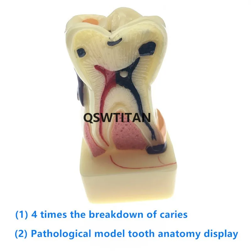 Model zębów 4 razy zębów patologii model kompleksowe przyzębia Model do nauczania badania modelu