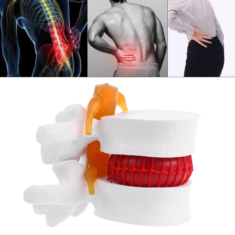 Human Anatomical Lumbar Disc Herniation Model Medical Learn Aid Anatomy Instrume D5QC