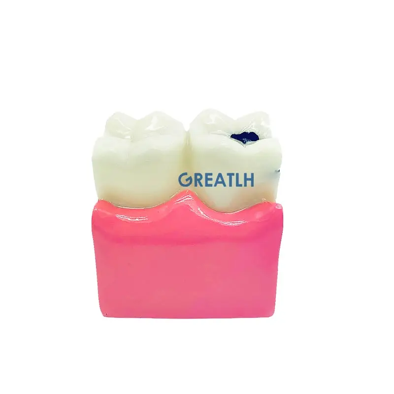 Teeth Model Teeth Disease Teaching Model Caries Model Dental Model Dentistry Products