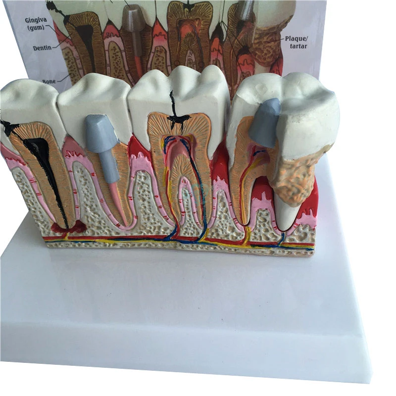 1pcs Dental Tooth Teeth Anatomical Model  Dental Anatomy Teeth Model Oversized Anatomy