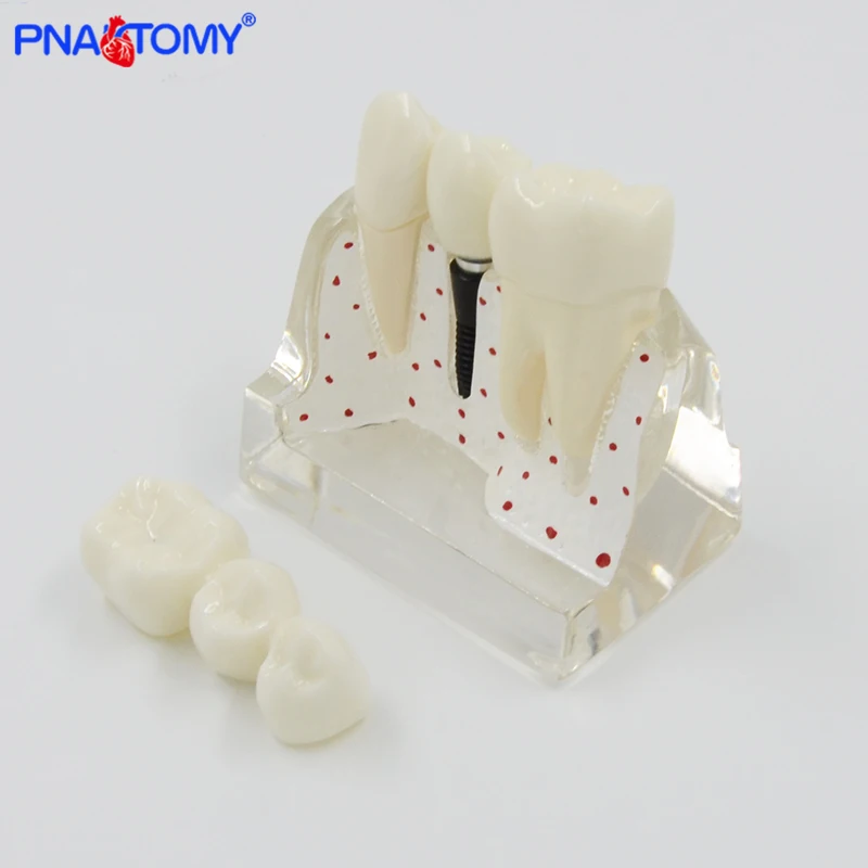 

4 TimesTransparent Dental Implant Model Analysis Crown Bridge Demonstration Dental Teeth Dentist Patience Model