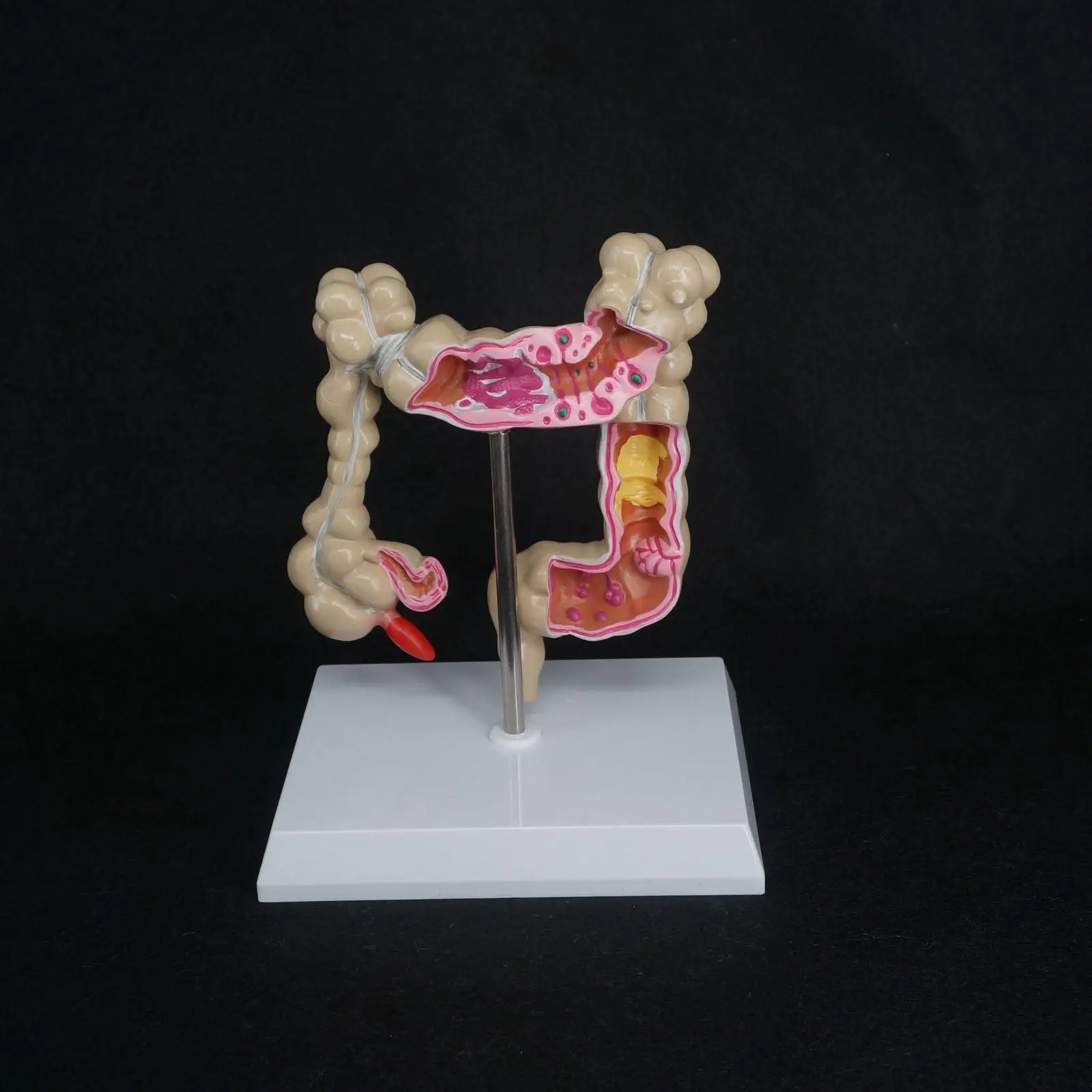 Anatomical Human Colon large Intestine Pathological Diseases Model Medical Organ Anatomy Teaching Resources