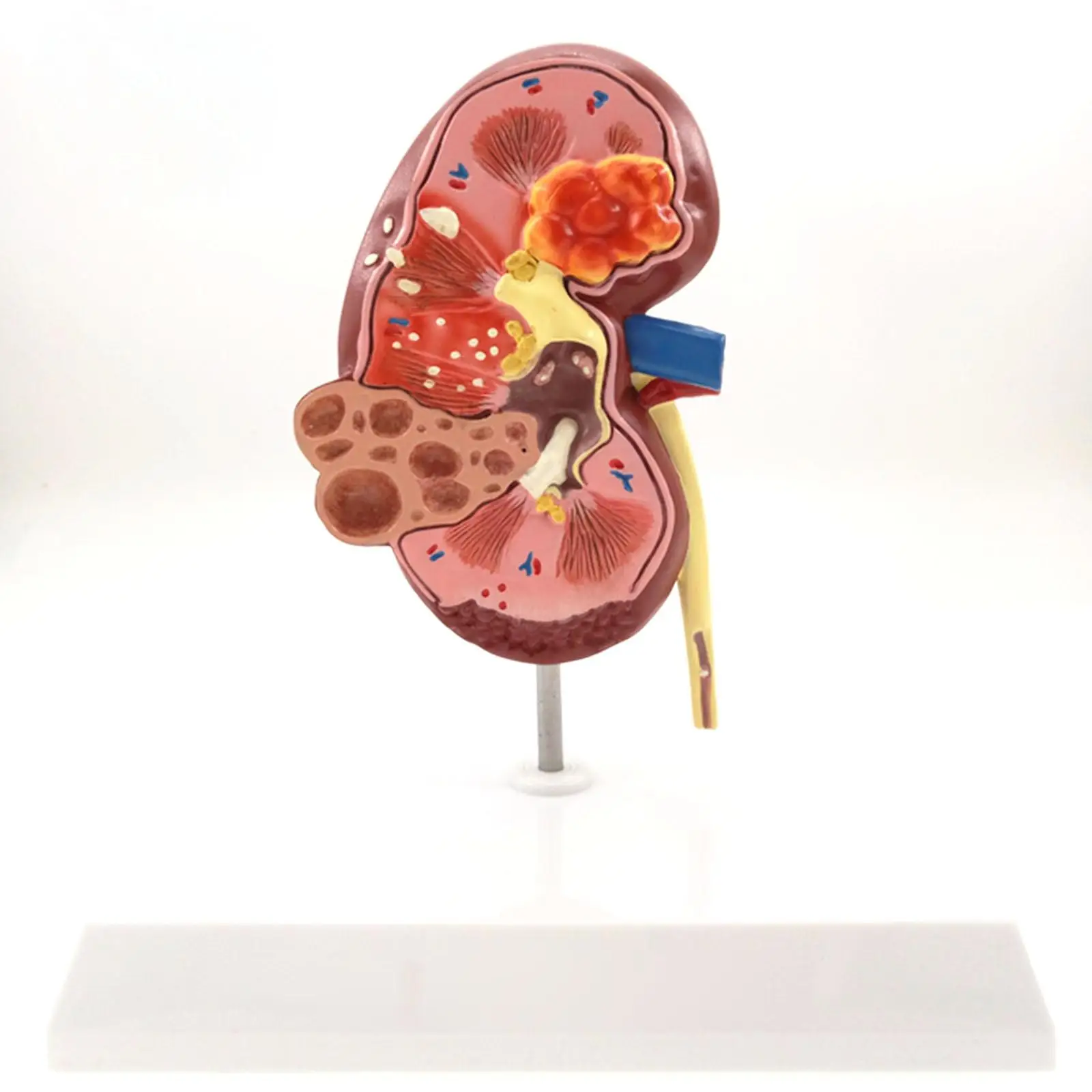 

Diseased Kidney Model Human Anatomical Medical Pathological Changes Specimen for Patient Education Teaching Resources