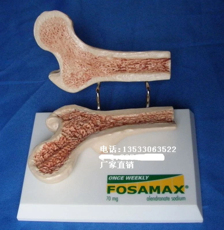 

Comparison of femoral profiles (Healthy and loose) Femoral head skeleton Medical teaching model