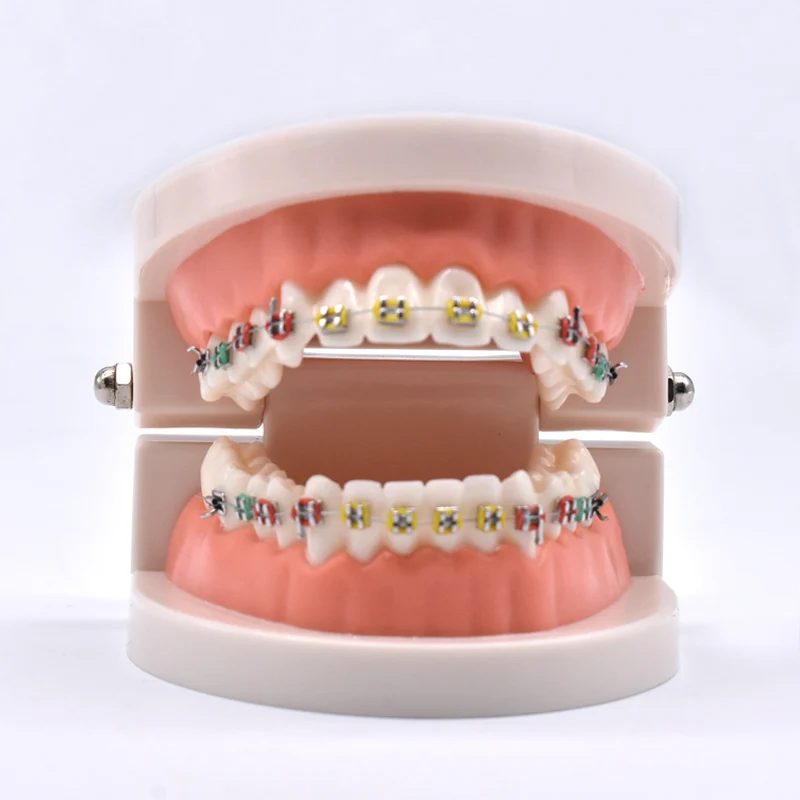 

Dental Orthodontic Treatment Model With Ortho Metal Ceramic Bracket Arch Wire Buccal Tube Ligature Ties