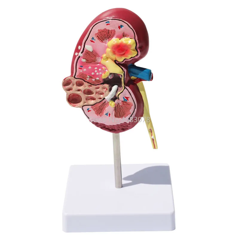 Human Body Organ Medical Kidney Anatomical Model Diseased Kidney  Model Human Anatomy Teaching Supplies