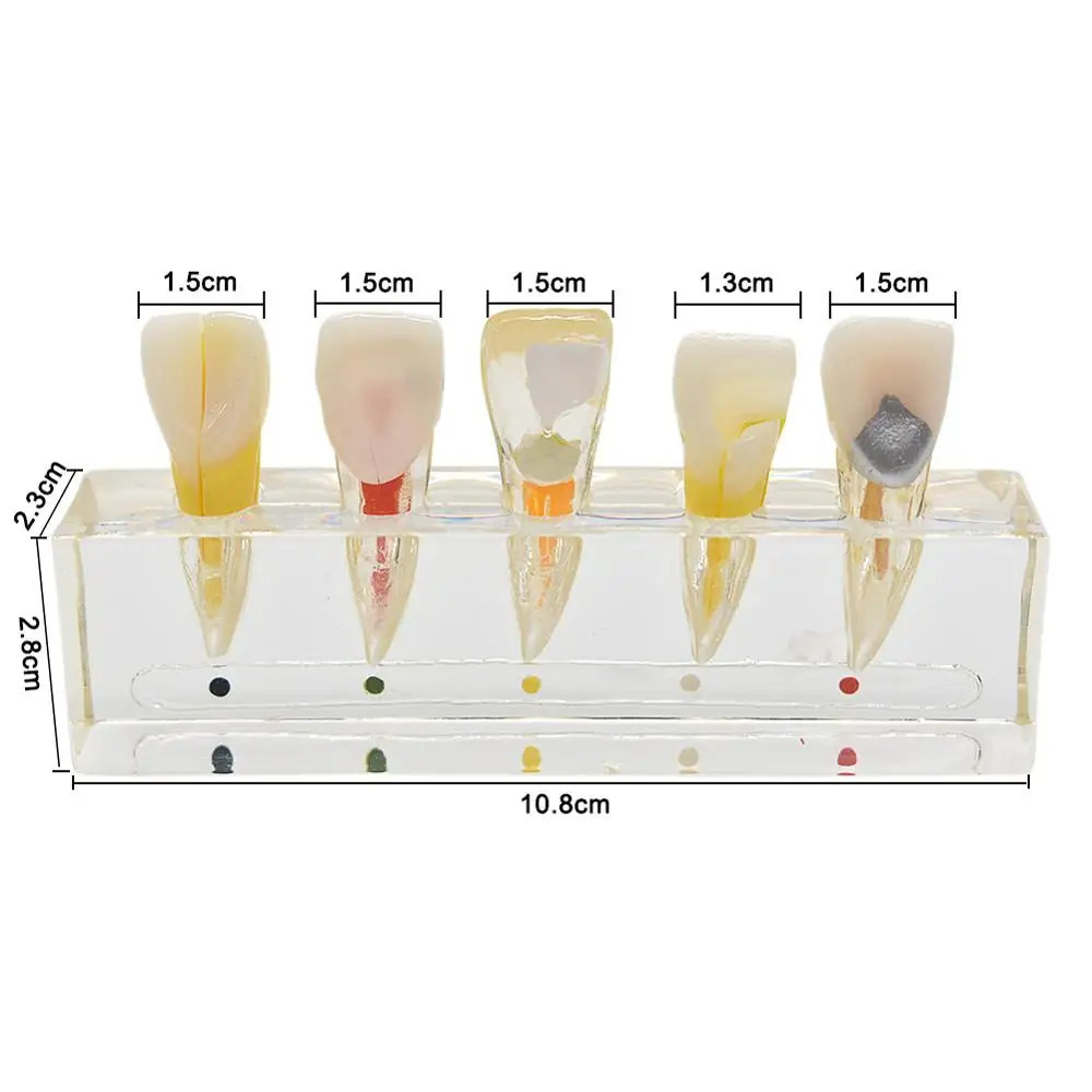 Dentaire endodontique pathologique, modèle de dents labiales antérieures et antérieures, laboratoire dentaire, modèle à h