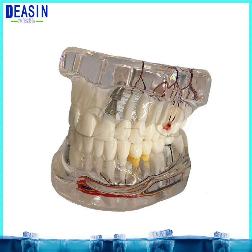 

Dental Implant Teeth Dental Pathological Teeth Implant Model Teaching Teeth Model & Restoration Bridge Tooth