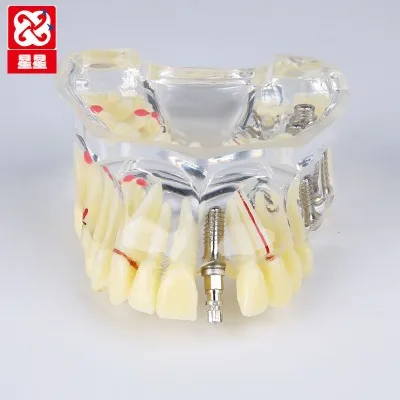 Crop Nail tooth Demo model Patient communication free shipping