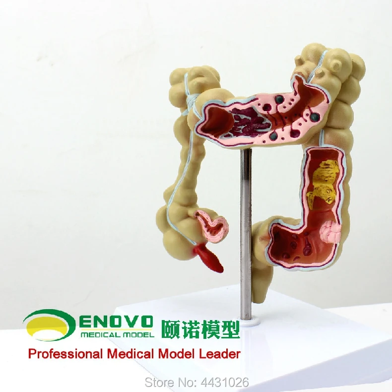 ENOVO Human Colon Disease Model Human Anatomy Of Large Intestine Model In Gastroenterology Department Of Anorectal Department