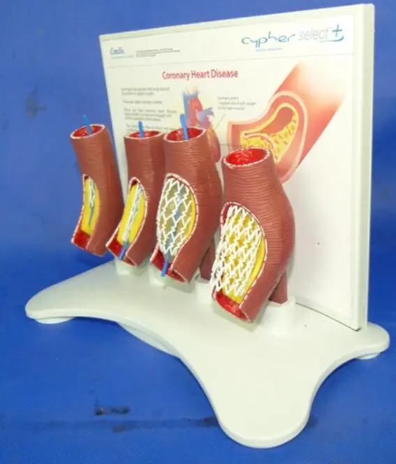 blood  vessel blockage model Anatomical model of human cardiac and cerebrovascular occlusion teaching