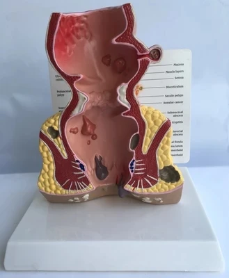 

Anatomical model of appendix and cecum Medical teaching model Human anorectal pathological model