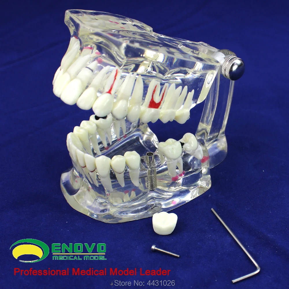 

ENOVO Dental model of dental dental disease