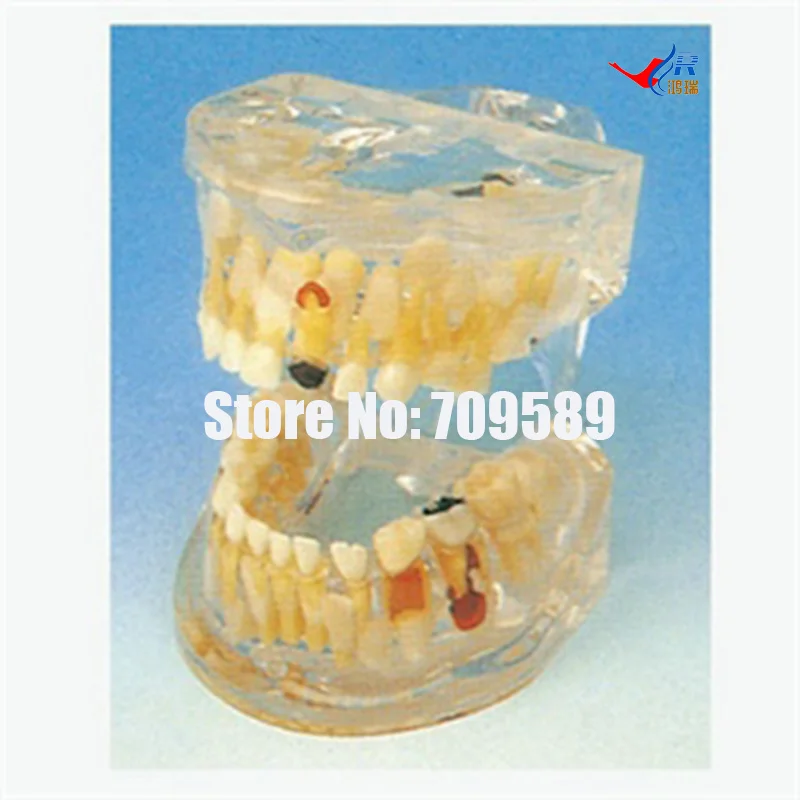 

Transparent Milk Teeth Pathology Model, Dental Care Model