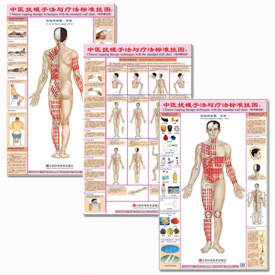 tecniche-cinesi-di-terapia-di-coppettazione-ba-guan-con-grafici-murali-standard-anteriore-posteriore-per-malattie-comuni