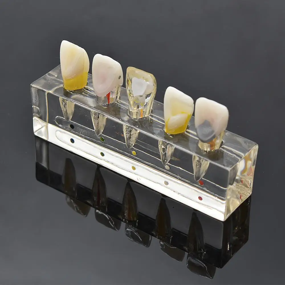 Dental endodontic pathological anterior front labial teeth model dental lab dentistry endo model