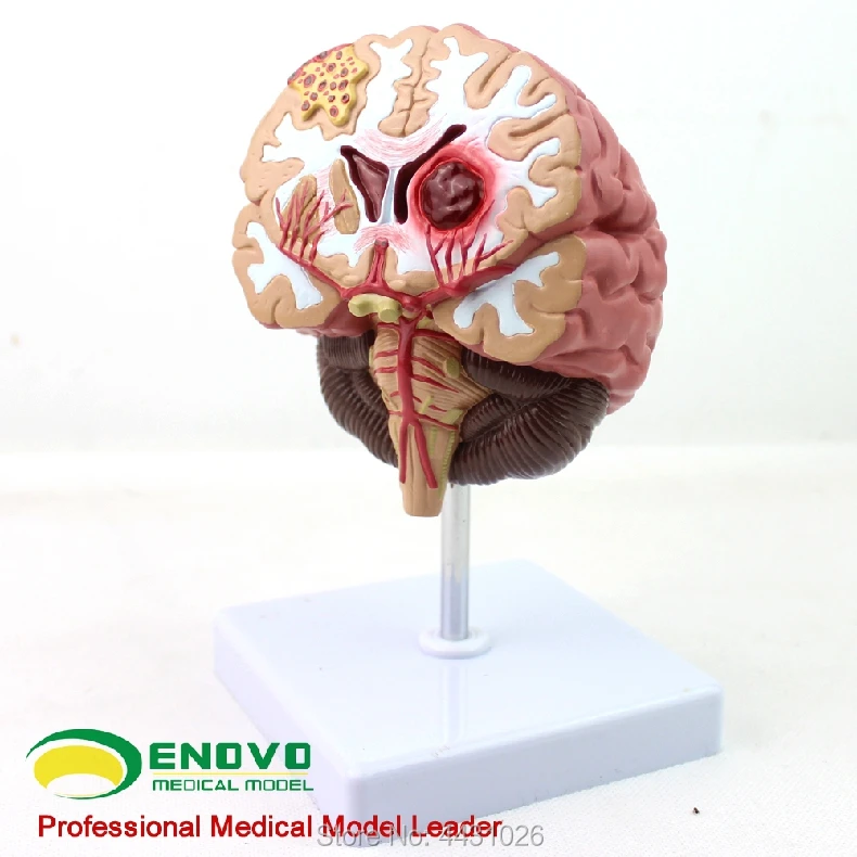 ENOVO Medical human. brain disease model brain model neurosurgery cerebral apoplexy cerebral hemorrhage