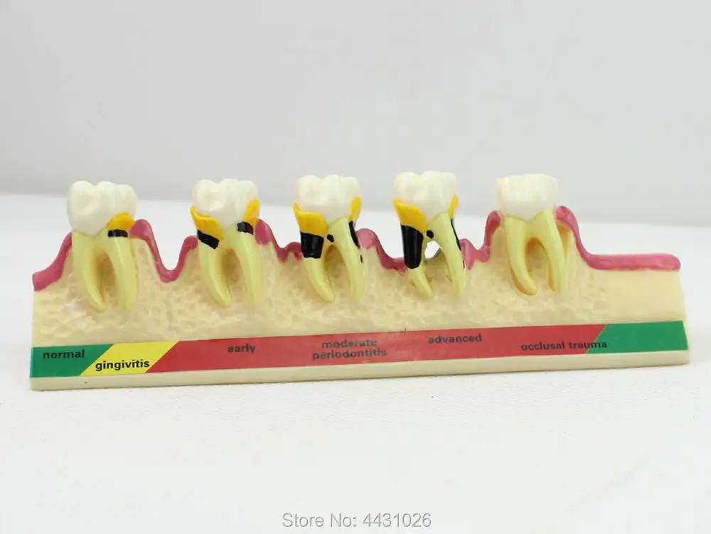 Enovo Oral Periodontal Disease Classification Model Gingivitis Degree Chronic Periodontitis Dentist Communication