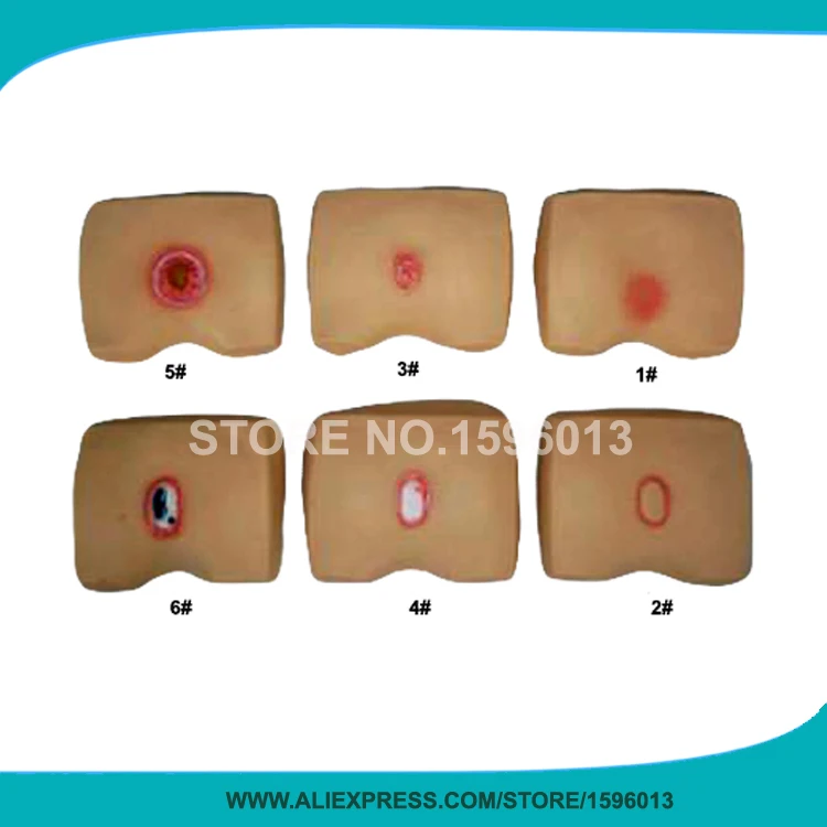 Decubitus Evolution Models,Pressure Sores Nursing Model,Buttock Skin with Decubitus Ulcer Simulator