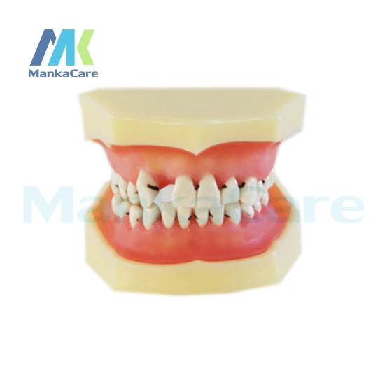 

Manka Care - Gingival can be easily removed for demonstrating bone resorption and sub-gingival calculus Oral Teeth Tooth Model