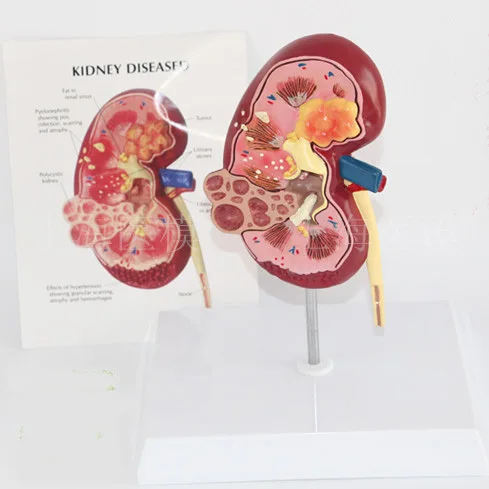 

Kidney disease model urology kidney nephron glomerular kidney model renal anatomy model free shipping