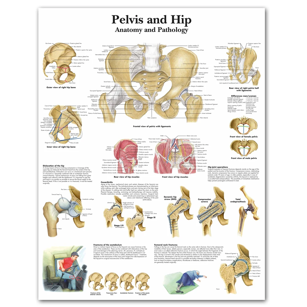 WANGART Pelvis and Hip Chart Anatomy and Pathology Poster Canvas Print Wall Pictures for Medical Education Office Home Decor