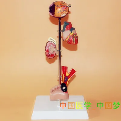 diabetes pathology model heart kidney eye model Medical Teaching free shipping