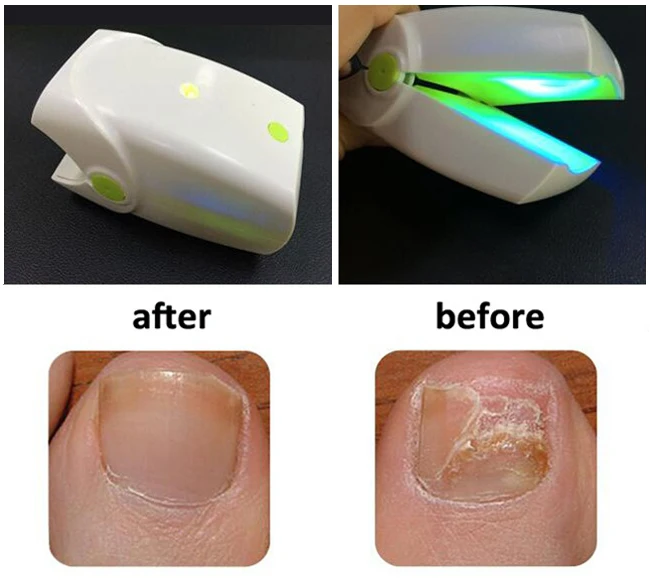 Highly Effective Rechargeable Nail Fungus Laser Treatment Device Nail Infection Onychomycosis Cure Nail Fungal Infections