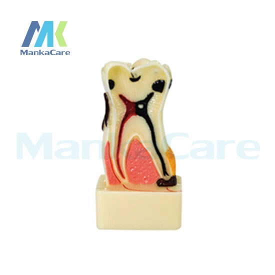 

Manka Care - 4Times periodontal disease/Made of imported resin Oral Model Teeth Tooth Model