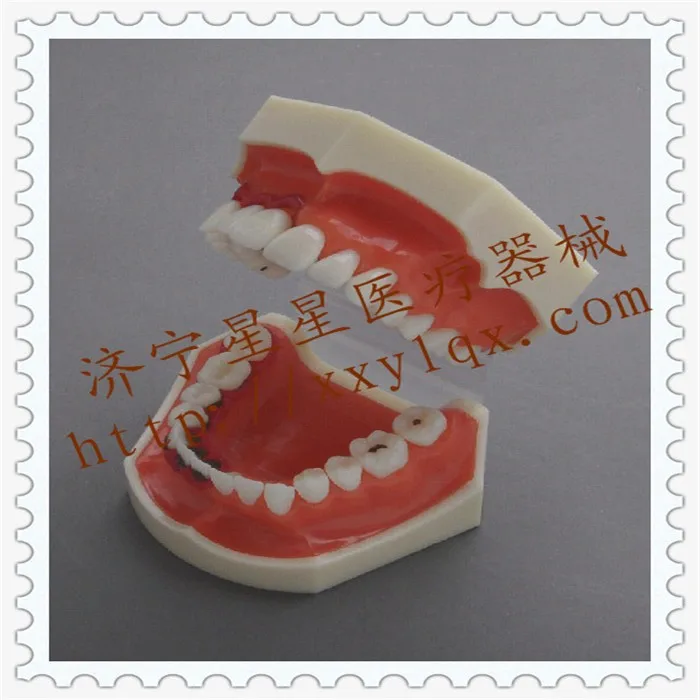 Periodontal Disease model Oral model Patient communication Dental teaching model 12.6cm*7.8cm*6.2cm free shipping