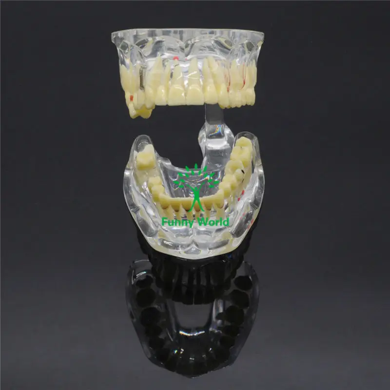 1 X Dental Implant Disease Tooth Pathological Extrusion Missing Teeth Model New